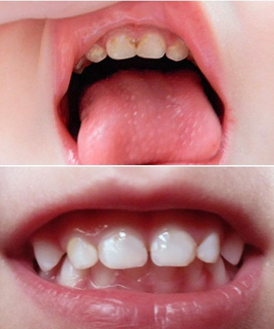 Реставрация зубов у детей в Перми